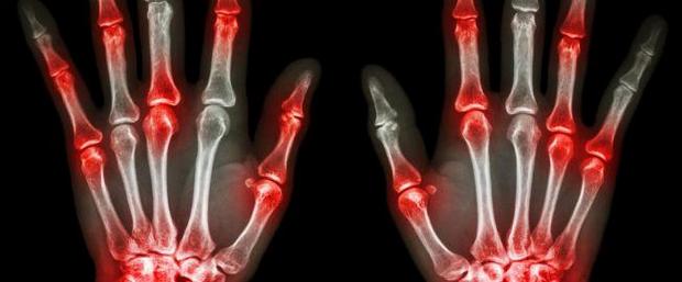 Ρευματοειδής αρθρίτιδα (ΡΑ). Συμπτώματα, διάγνωση και θεραπεία