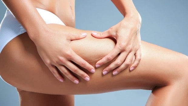 Γυναίκα - γυναικείο σώμα με κυτταρίτιδα στα πόδια από κακή διατροφή και συνήθειες